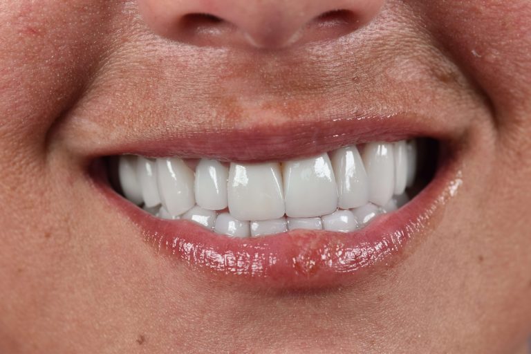 Diseño de Sonrisa (Smile Makeover)