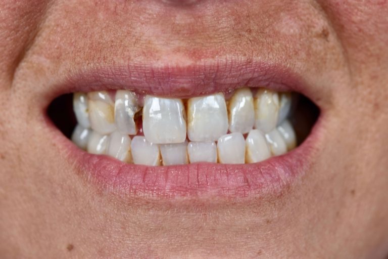 Diseño de Sonrisa (Smile Makeover)